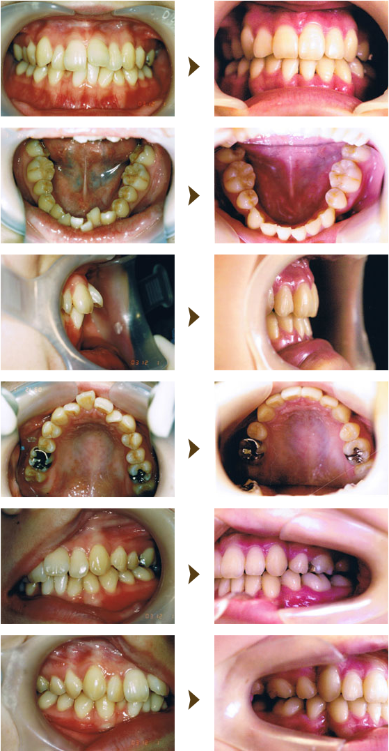 部分矯正（プチ矯正）症例：1