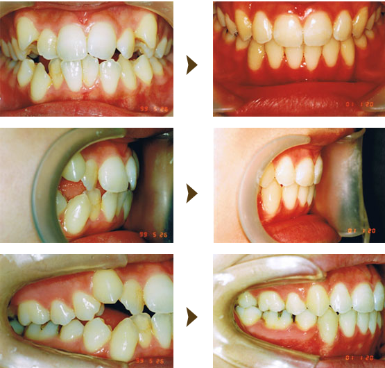 部分矯正（プチ矯正）症例：2