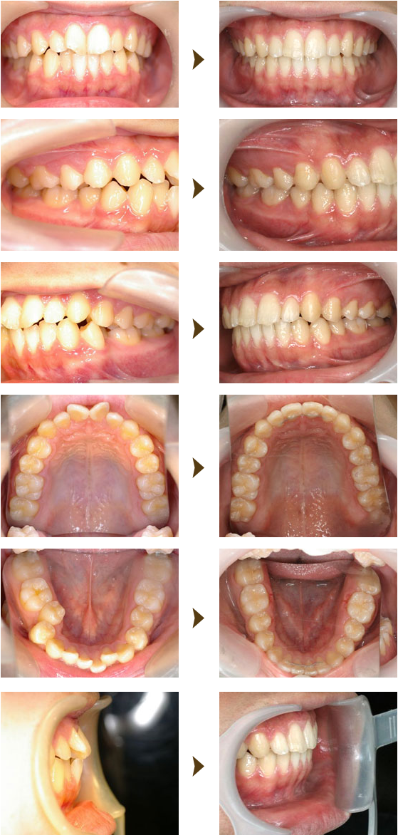 部分矯正（プチ矯正）症例：3