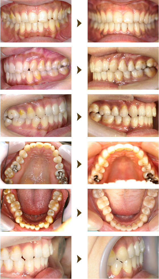 部分矯正（プチ矯正）症例：4