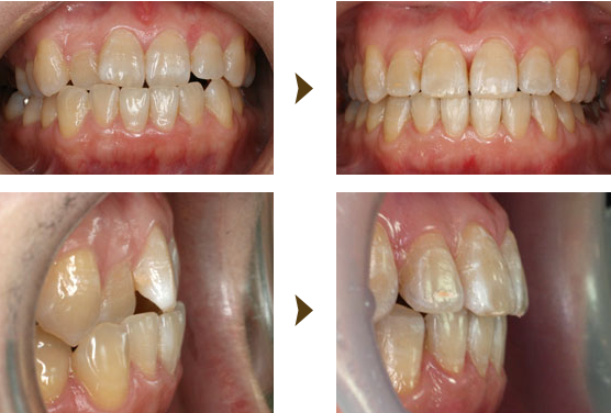 部分矯正（プチ矯正）症例：7