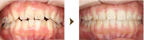 部分矯正（プチ矯正）症例：8