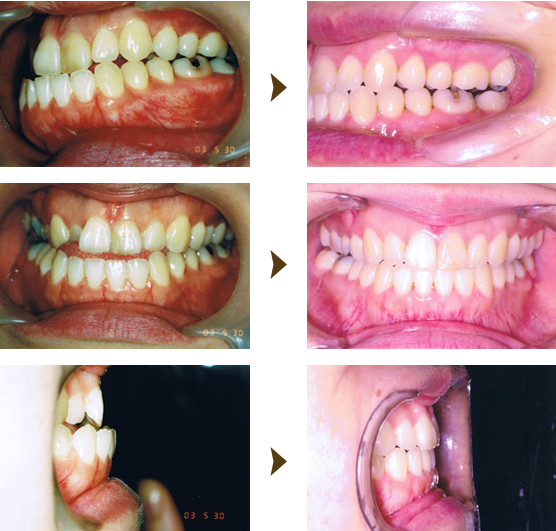反対咬合（受け口）矯正症例：1