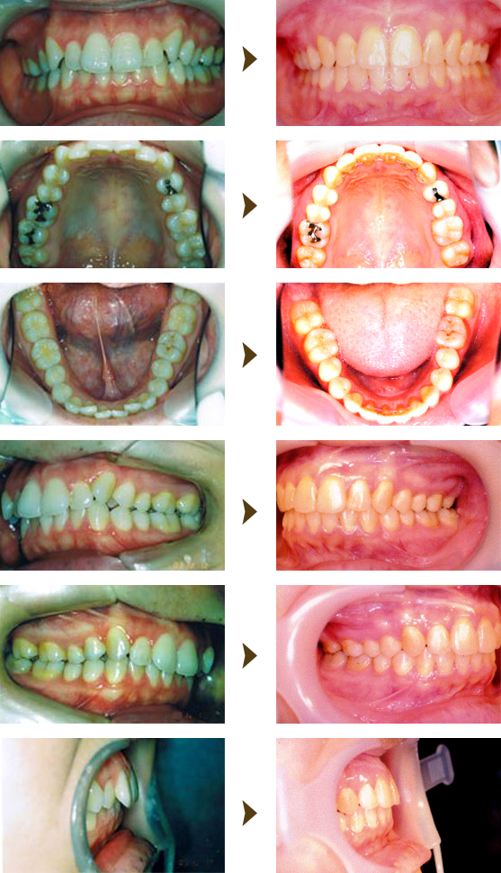 スライス矯正症例：3　小臼歯非抜歯症例