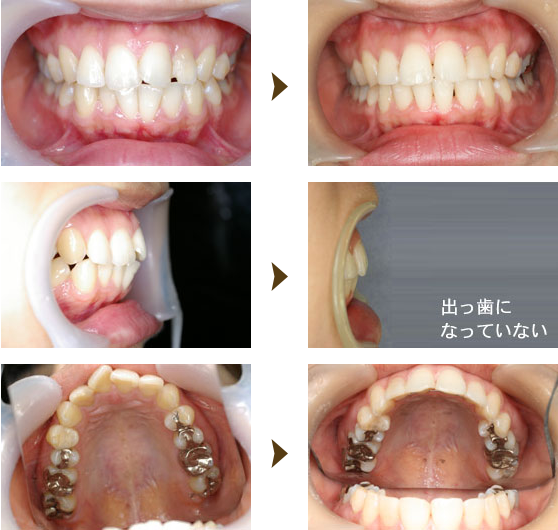 早く終わる矯正治療（スピード矯正）症例：1