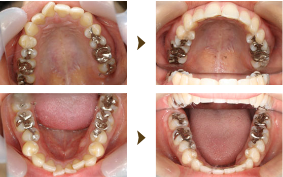 クリアアライナー症例：2