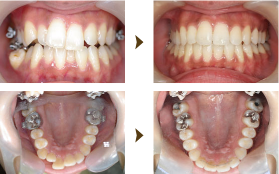クリアアライナー症例：1