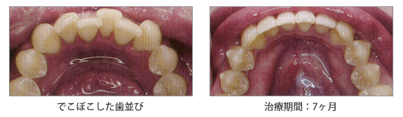 インビザライン症例7：使用したインビザライン・アライナー数14個