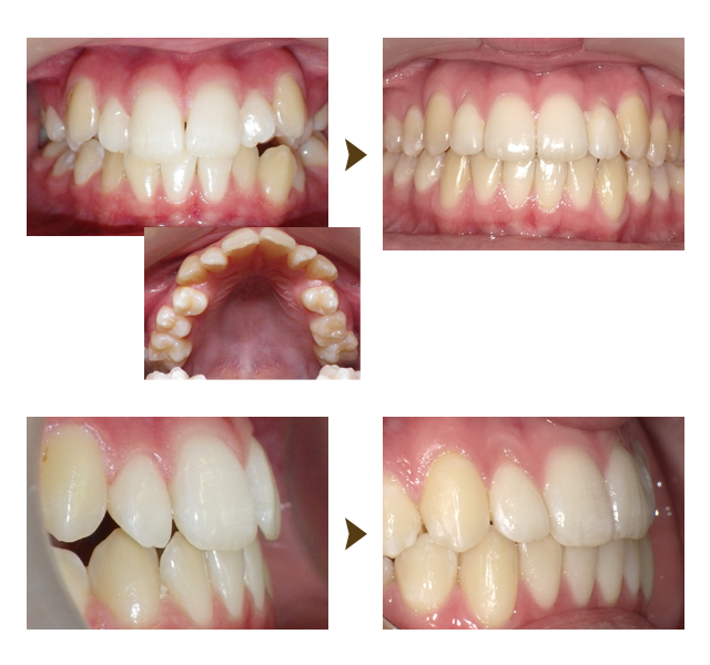 インビザライン症例1