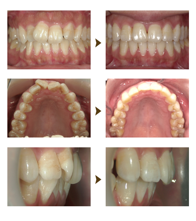インビザライン症例2