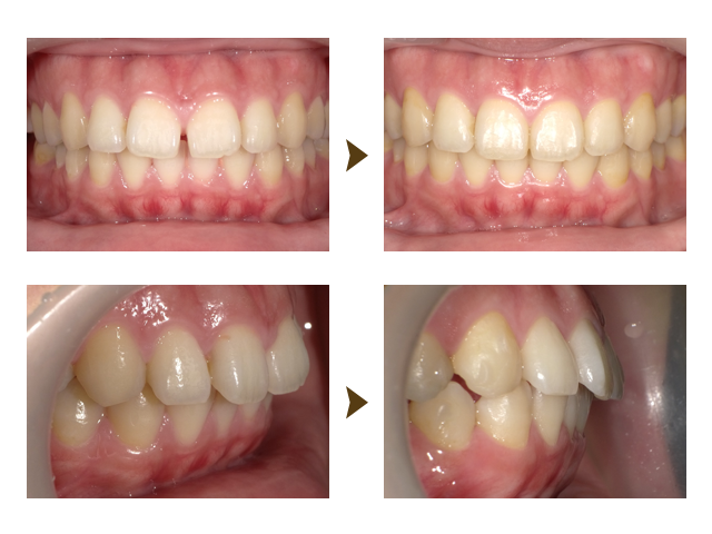 インビザライン症例3