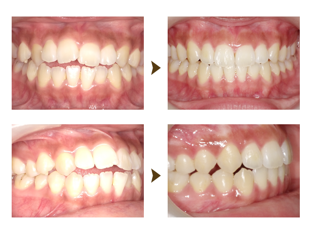 インビザライン症例4